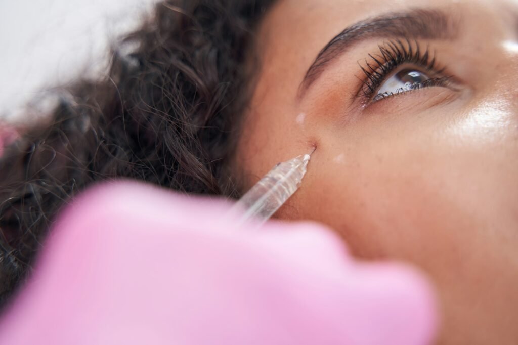 Syringe needle penetrates under the skin under the eye along pre-marked contours